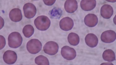 plaquetas-Giant_platelets
